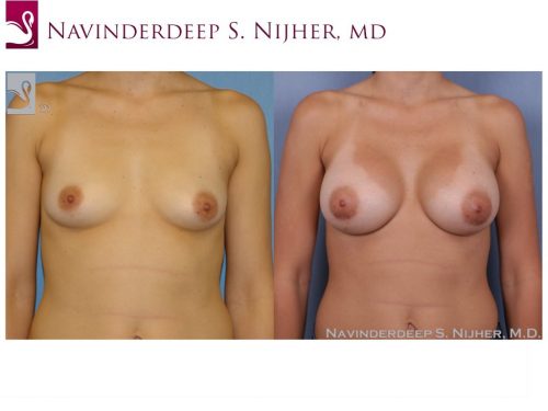 Breast Augmentation Case #50064 (Image 1)