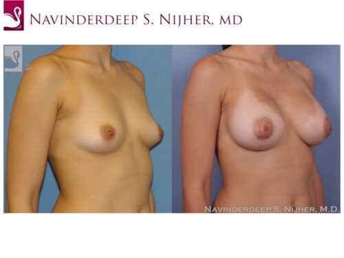 Breast Augmentation Case #50064 (Image 2)