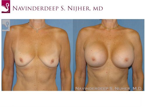 Breast Augmentation Case #48309 (Image 1)