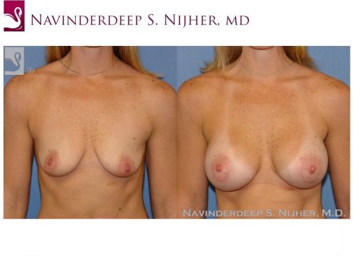 Breast Augmentation Case #42792 (Image 1)