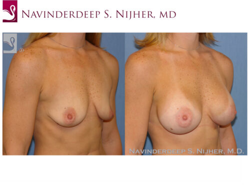 Breast Augmentation Case #42792 (Image 2)