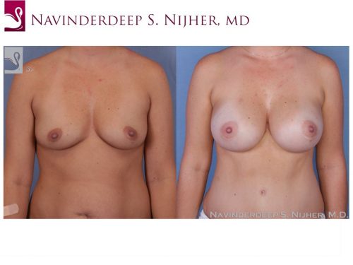 Breast Augmentation Case #33055 (Image 1)
