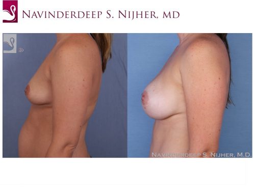 Breast Augmentation Case #33055 (Image 3)