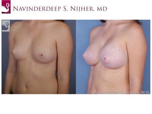 Breast Augmentation Case #52728 (Image 2)