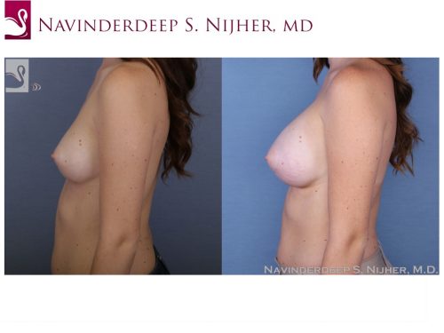 Breast Augmentation Case #52728 (Image 3)