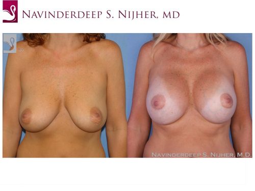 Breast Augmentation with Mastopexy (Breast Lift) Case #24752 (Image 1)