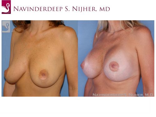 Breast Augmentation with Mastopexy (Breast Lift) Case #24752 (Image 2)
