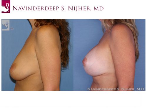 Breast Augmentation with Mastopexy (Breast Lift) Case #24752 (Image 3)