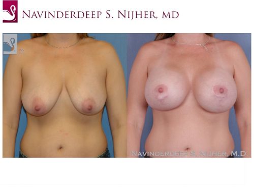 Breast Augmentation with Mastopexy (Breast Lift) Case #41358 (Image 1)