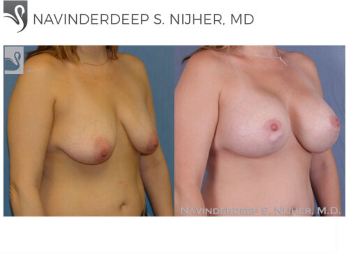 Breast Augmentation with Mastopexy (Breast Lift) Case #41358 (Image 2)