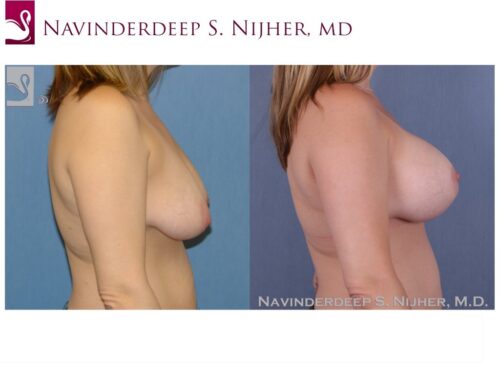 Breast Augmentation with Mastopexy (Breast Lift) Case #41358 (Image 3)