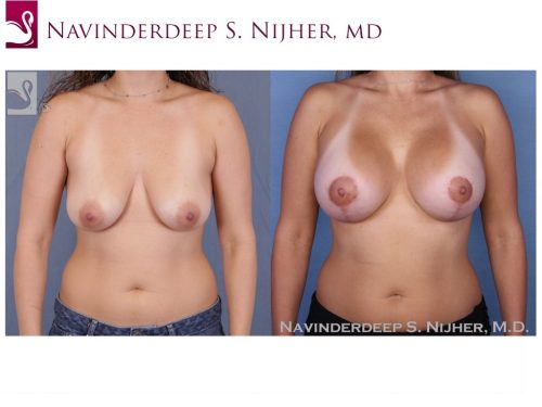 Breast Augmentation with Mastopexy (Breast Lift) Case #52391 (Image 1)