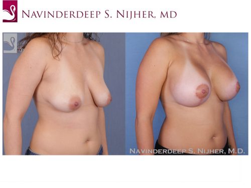 Breast Augmentation with Mastopexy (Breast Lift) Case #52391 (Image 2)
