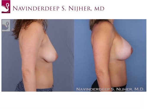 Breast Augmentation with Mastopexy (Breast Lift) Case #52391 (Image 3)