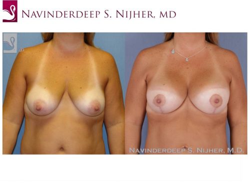 Breast Augmentation with Mastopexy (Breast Lift) Case #48614 (Image 1)
