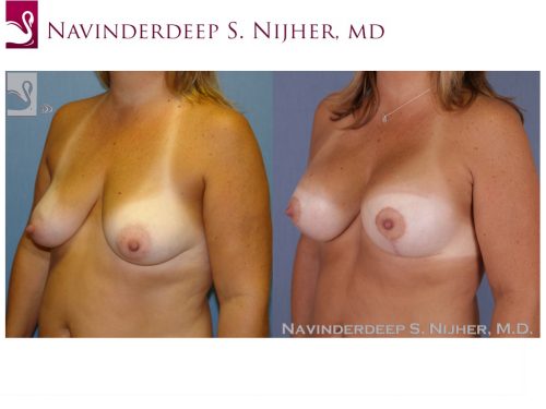 Breast Augmentation with Mastopexy (Breast Lift) Case #48614 (Image 2)