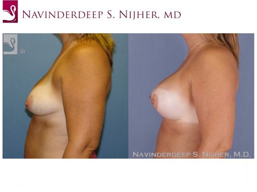 Breast Augmentation with Mastopexy (Breast Lift) Case #48614 (Image 3)