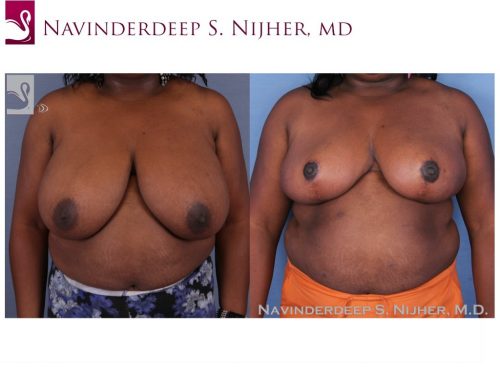 Female Breast Reduction Case #53365 (Image 1)