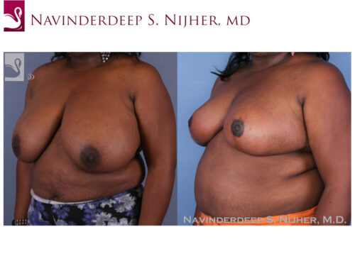 Female Breast Reduction Case #53365 (Image 2)