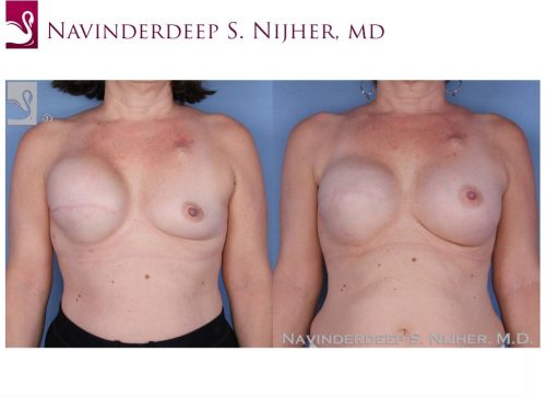 Breast Reconstruction Case #15749 (Image 1)