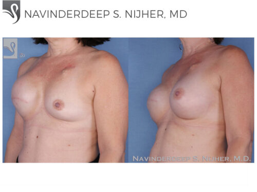 Breast Reconstruction Case #15749 (Image 2)