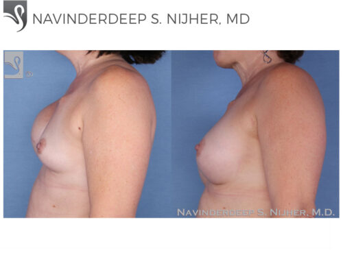 Breast Reconstruction Case #15749 (Image 3)