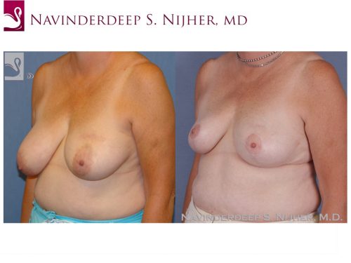 Breast Reconstruction Case #47753 (Image 2)