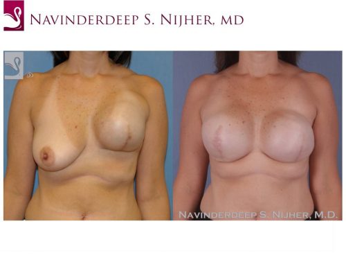 Breast Reconstruction Case #44713 (Image 1)