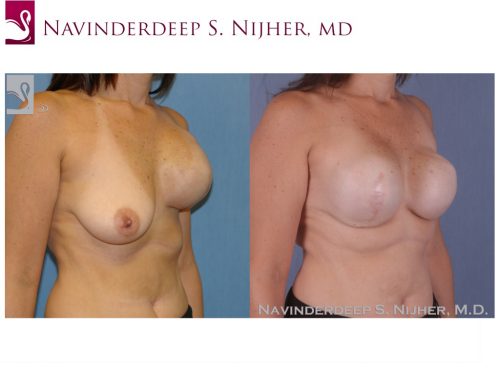 Breast Reconstruction Case #44713 (Image 2)
