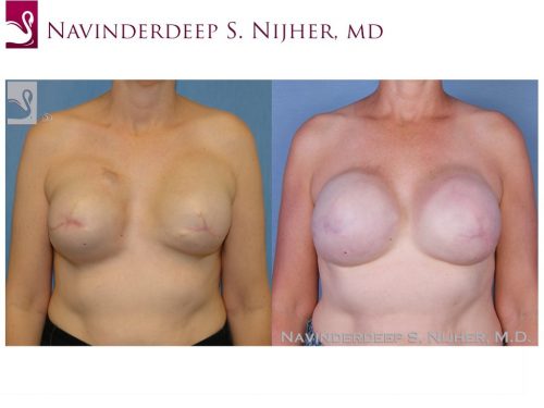 Breast Reconstruction Case #45095 (Image 1)