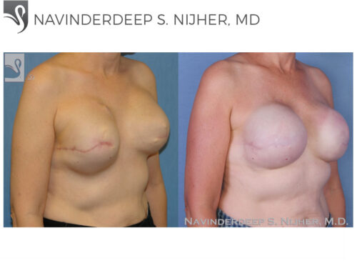 Breast Reconstruction Case #45095 (Image 2)