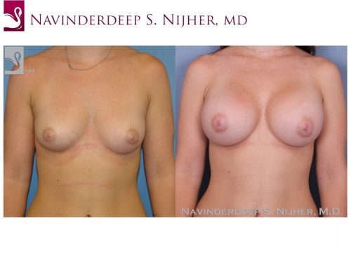 Breast Augmentation Case #38904 (Image 1)