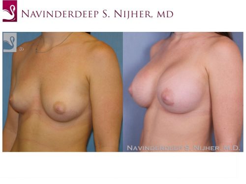 Breast Augmentation Case #38904 (Image 2)