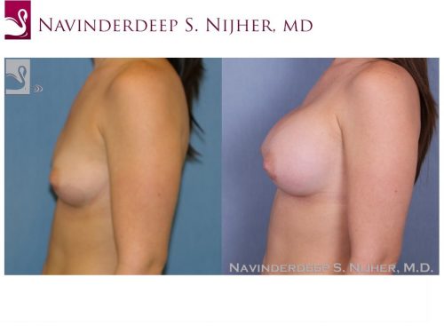 Breast Augmentation Case #38904 (Image 3)