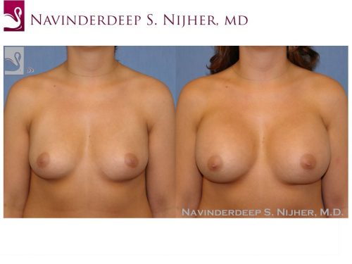 Breast Augmentation Case #40166 (Image 1)