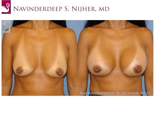 Breast Augmentation Case #43824 (Image 1)
