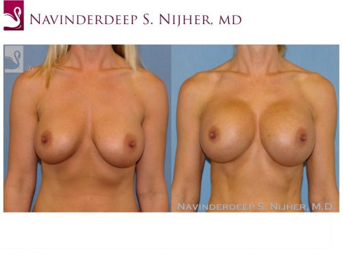 Breast Augmentation Case #45044 (Image 1)