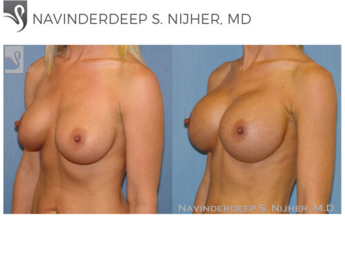 Breast Augmentation Case #45044 (Image 2)