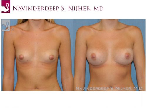 Breast Augmentation Case #48014 (Image 1)