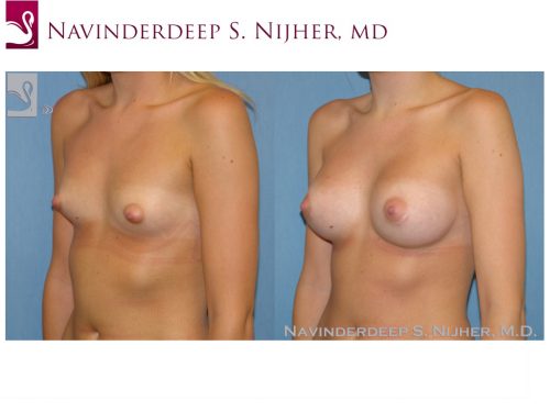 Breast Augmentation Case #48014 (Image 2)