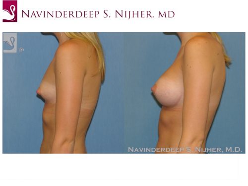 Breast Augmentation Case #48014 (Image 3)
