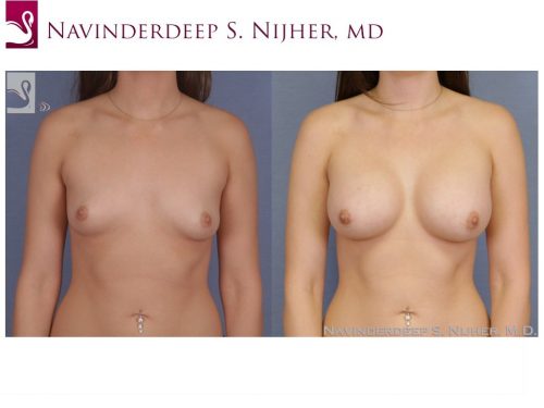Breast Augmentation Case #49713 (Image 1)