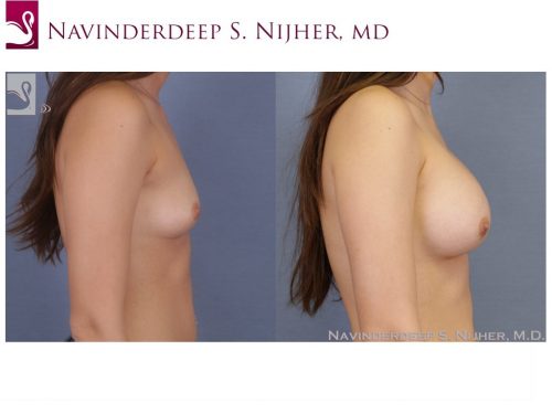 Breast Augmentation Case #49713 (Image 3)