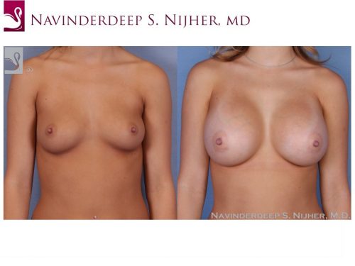 Breast Augmentation Case #53297 (Image 1)