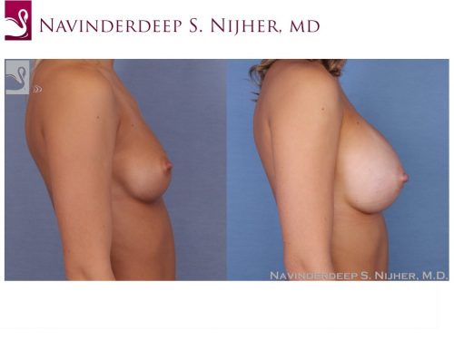 Breast Augmentation Case #53297 (Image 3)