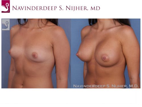 Breast Augmentation Case #50240 (Image 2)