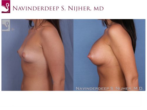 Breast Augmentation Case #50240 (Image 3)