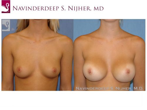 Breast Augmentation Case #41797 (Image 1)