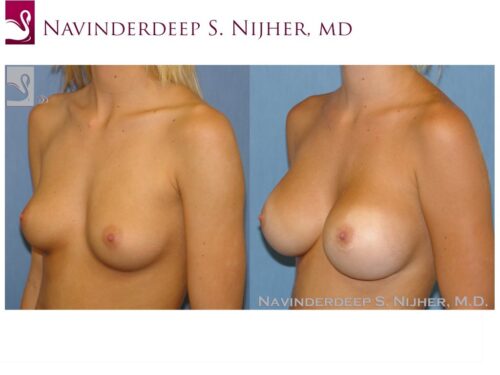 Breast Augmentation Case #41797 (Image 2)