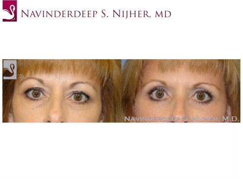 Eyelid Surgery Case #8797 (Image 1)